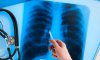 Чотири випадки туберкульозу у дітей зареєстровано на Сумщині від початку року