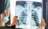 Україна синхронізує нормативну базу у боротьбі з туберкульозом до європейських стандартів